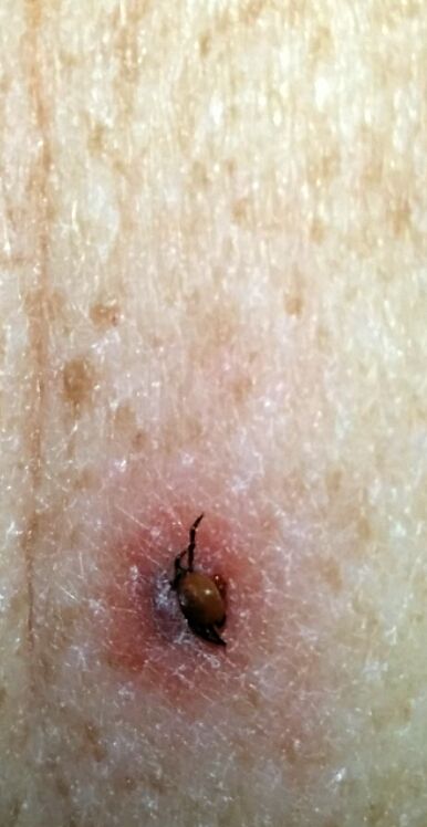 Tick bites and Lyme disease
