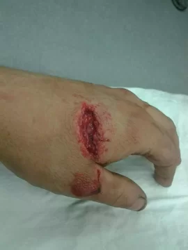 [Hearth.com] Chainsaw Stupidity *Graphic*