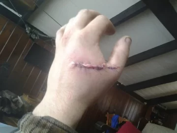 [Hearth.com] Chainsaw Stupidity *Graphic*