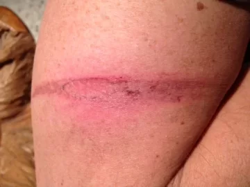 [Hearth.com] How many times  do you burn yourself?