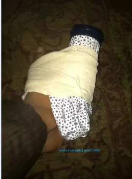 [Hearth.com] Could Not Scrounge This Weekend -- Bruised Ligament Ankle