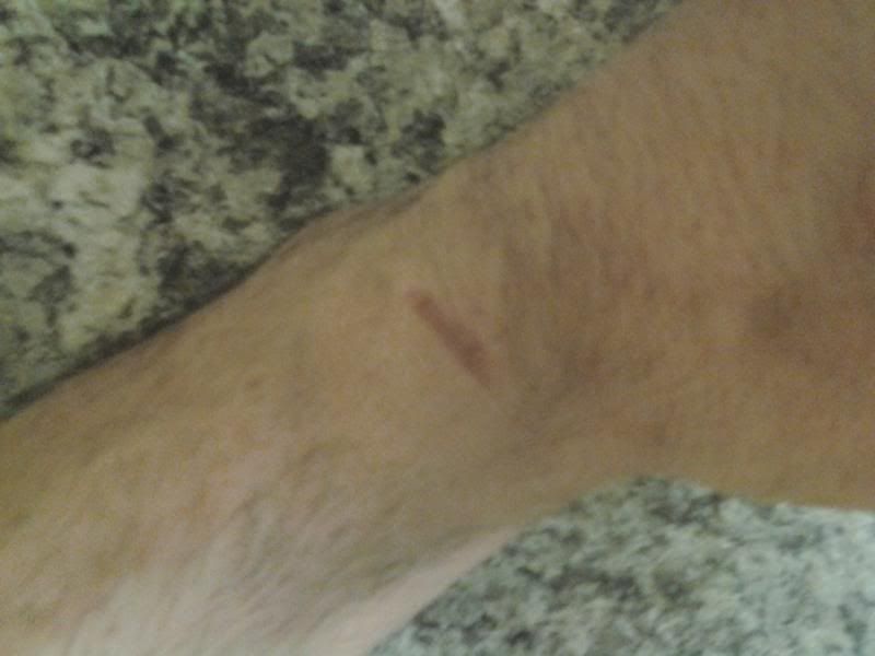 [Hearth.com] Burn bite Tally 2013-2014.